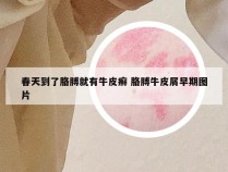 春天到了胳膊就有牛皮癣 胳膊牛皮屑早期图片