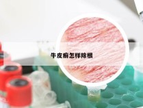 牛皮癣怎样除根