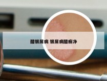 醋银屑病 银屑病醋癣净