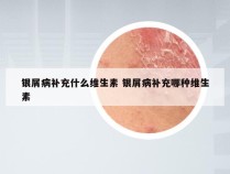 银屑病补充什么维生素 银屑病补充哪种维生素