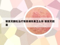 银屑灵颗粒治疗银屑病效果怎么样 银屑灵胶囊