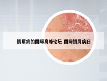 银屑病的国际高峰论坛 国际银屑病日