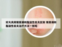 好大夫网银屑病和脂溢性皮炎区别 银屑病和脂溢性皮炎治疗方法一样吗
