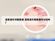 湿毒清片对银屑病 湿毒清片银屑病可以吃吗?