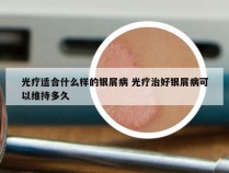 光疗适合什么样的银屑病 光疗治好银屑病可以维持多久