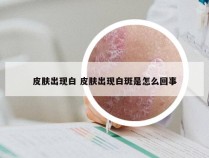 皮肤出现白 皮肤出现白斑是怎么回事