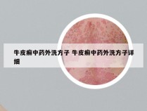 牛皮癣中药外洗方子 牛皮癣中药外洗方子详细