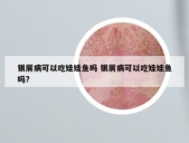 银屑病可以吃娃娃鱼吗 银屑病可以吃娃娃鱼吗?