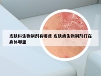 皮肤科生物制剂有哪些 皮肤病生物制剂打在身体哪里