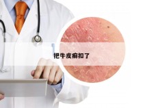 把牛皮癣扣了