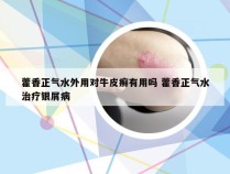 藿香正气水外用对牛皮癣有用吗 藿香正气水治疗银屑病