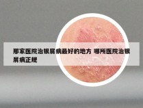 那家医院治银屑病最好的地方 哪所医院治银屑病正规