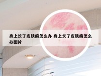 身上长了皮肤癣怎么办 身上长了皮肤癣怎么办图片