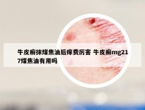 牛皮癣抹煤焦油后痒费厉害 牛皮癣mg217煤焦油有用吗