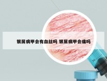 银屑病甲会有血丝吗 银屑病甲会痛吗