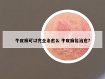 牛皮癣可以完全治愈么 牛皮癣能治愈?