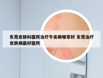 东莞皮肤科医院治疗牛皮癣哪家好 东莞治疗皮肤病最好医院