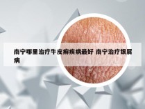 南宁哪里治疗牛皮癣疾病最好 南宁治疗银屑病
