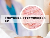 寻常型牛皮癣禁忌 寻常型牛皮肤癣用什么药最好