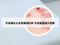 牛皮癣从小点发展成红块 牛皮癣变成小疙瘩