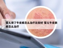 婴儿得了牛皮癣怎么治疗比较好 婴儿牛皮肤癣怎么治疗