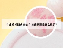 牛皮癣初期啥症状 牛皮癣初期是什么样的?