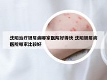 沈阳治疗银屑病哪家医院好得快 沈阳银屑病医院哪家比较好