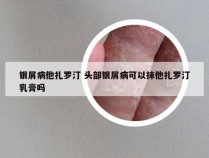 银屑病他扎罗汀 头部银屑病可以抹他扎罗汀乳膏吗
