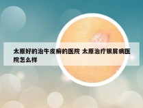 太原好的治牛皮癣的医院 太原治疗银屑病医院怎么样