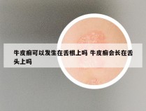 牛皮癣可以发生在舌根上吗 牛皮癣会长在舌头上吗
