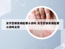 关节型银屑病能要小孩吗 关节型银屑病能要小孩吗女性
