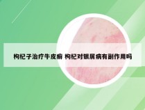 枸杞子治疗牛皮癣 枸杞对银屑病有副作用吗