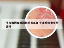 牛皮癣烤光时间长吗怎么办 牛皮癣烤电有危害吗