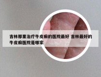 吉林那里治疗牛皮癣的医院最好 吉林最好的牛皮癣医院是哪家