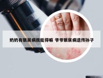 奶奶有银屑病我能得嘛 爷爷银屑病遗传孙子