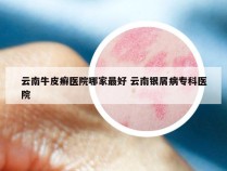 云南牛皮癣医院哪家最好 云南银屑病专科医院