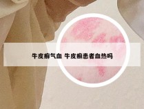 牛皮癣气血 牛皮癣患者血热吗
