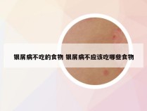 银屑病不吃的食物 银屑病不应该吃哪些食物