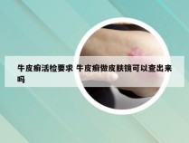 牛皮癣活检要求 牛皮癣做皮肤镜可以查出来吗