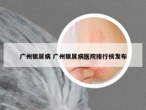 广州银屑病 广州银屑病医院排行榜发布