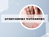 治疗顽固牛皮癣的偏方 专治牛皮顽癣的偏方