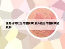 紫外线可以治疗银屑病 紫外线治疗银屑病的机制