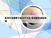 常州牛皮癣哪个医院可以治 常州银屑病皮肤病