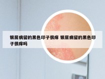 银屑病留的黑色印子很痒 银屑病留的黑色印子很痒吗
