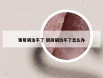 银屑病治不了 银屑病治不了怎么办