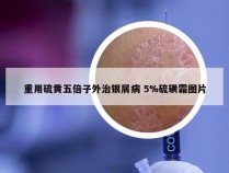 重用硫黄五倍子外治银屑病 5%硫磺霜图片