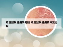 红皮型银屑病研究所 红皮型银屑病的恢复过程
