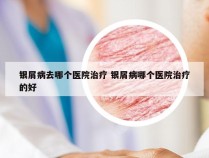 银屑病去哪个医院治疗 银屑病哪个医院治疗的好