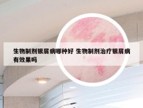 生物制剂银屑病哪种好 生物制剂治疗银屑病有效果吗