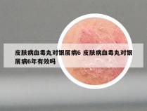 皮肤病血毒丸对银屑病6 皮肤病血毒丸对银屑病6年有效吗